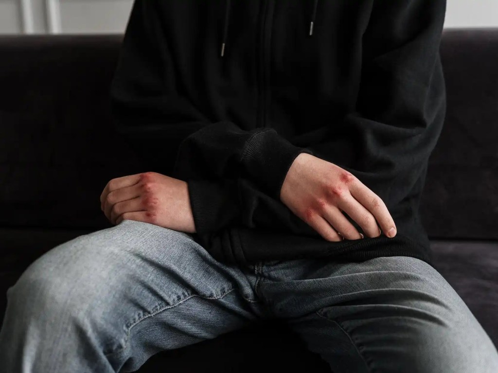 How Effective is CBT as a Psychological Intervention used with Clients who Intentionally&nbsp;Self-Harm?